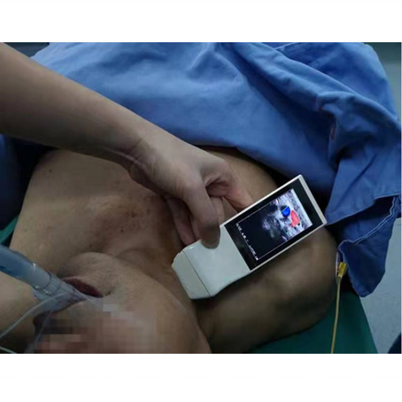 WIFI Wireless Color Probe GYN Ultrasound Linear Probe With Display Anesthesia Puncture Navigation Handheld Ultrasound